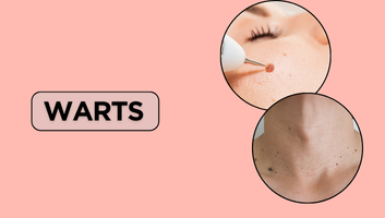 Warts Removal